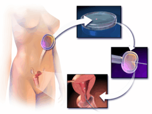Fertiliteitsproblematiek.
