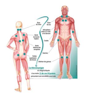 Fybromyalgie